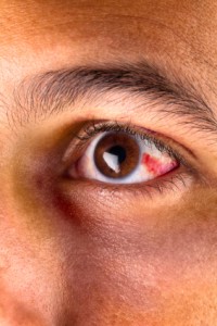 Red Eye, Conjunctivitis and Subconjunctival Bleed: