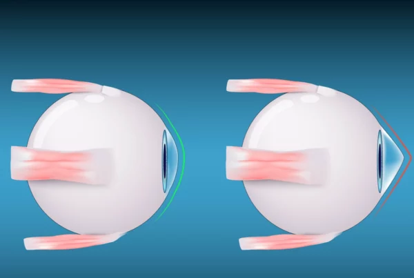 banner image graphic depiction of keratoconus