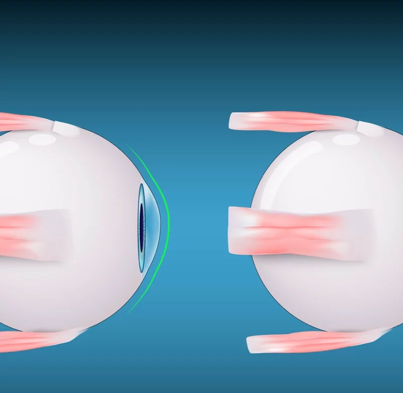 banner image graphic depiction of keratoconus