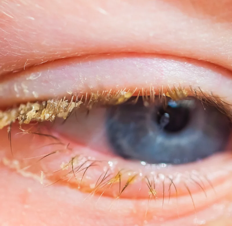 Blepharitis is an inflammation of the eyelids