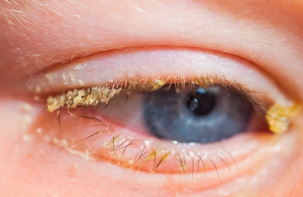 Blepharitis