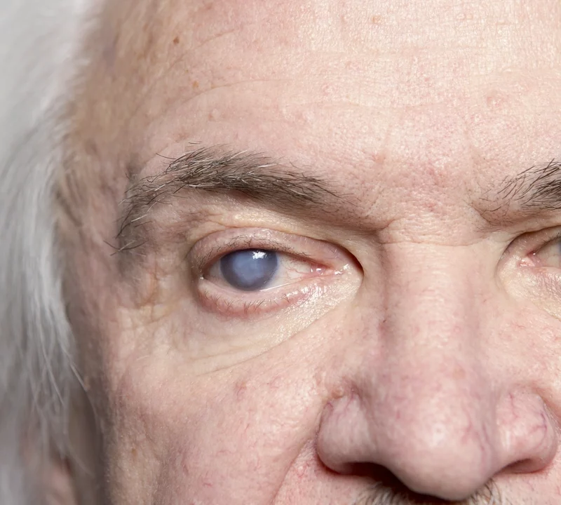 man with cataract in one eye