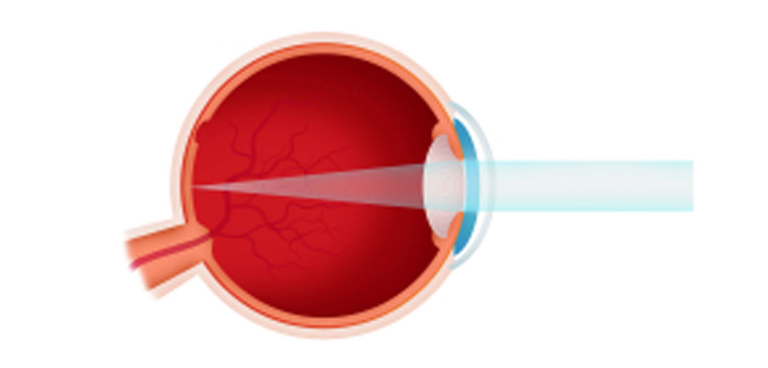 graphic depiction of Emmetropia