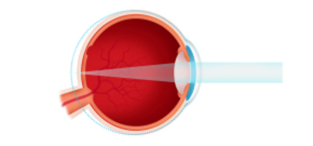 graphic depiction of Hyperopia