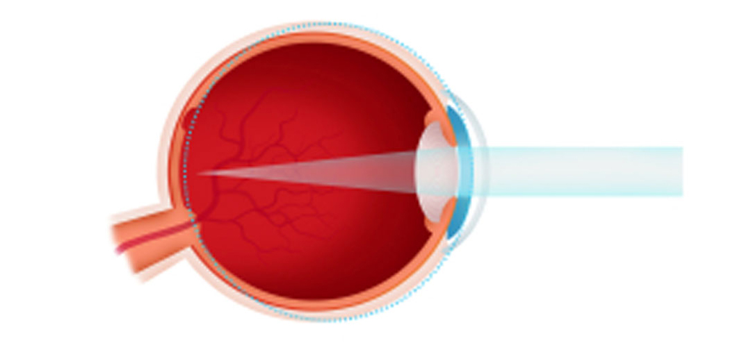 graphic depiction of Myopia