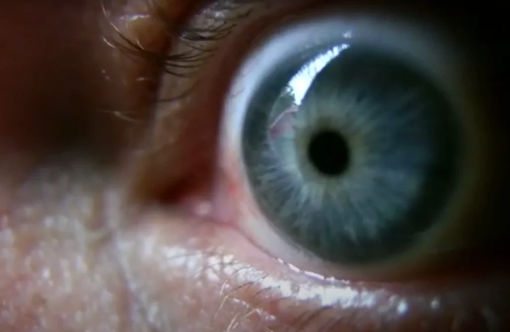 video poster for digital corneal photography