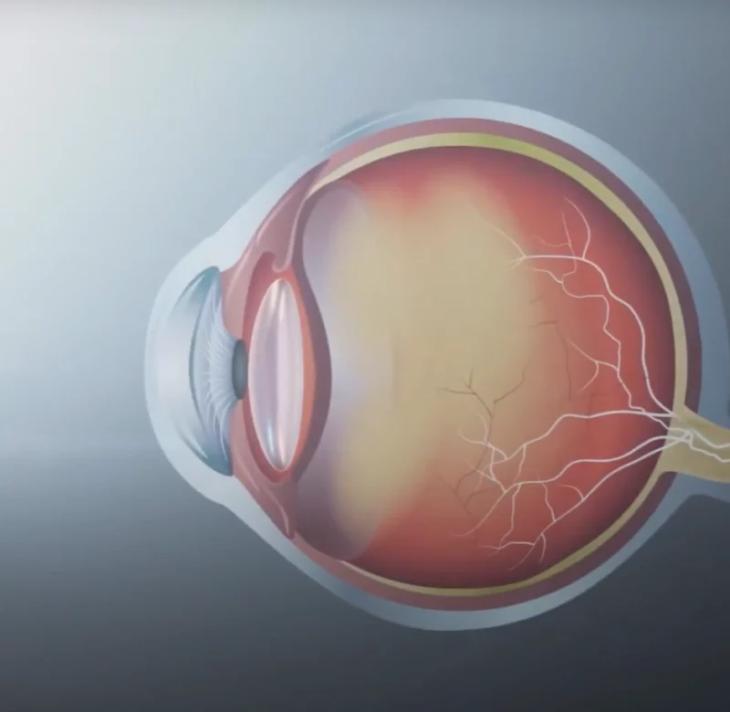 presbyopia eyeball diagram
