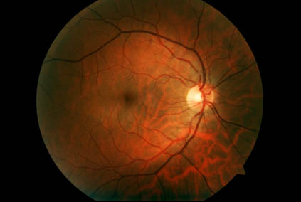 diabetic retina