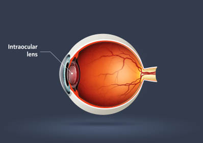 intraocular lens illustration