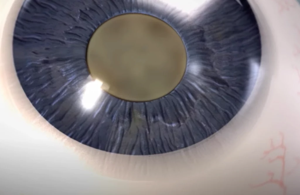 cataracts video poster