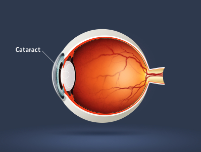 parrelli optical eye health cataract diagram