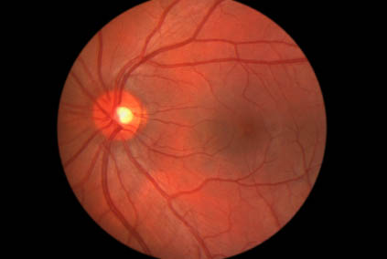 healthy retina