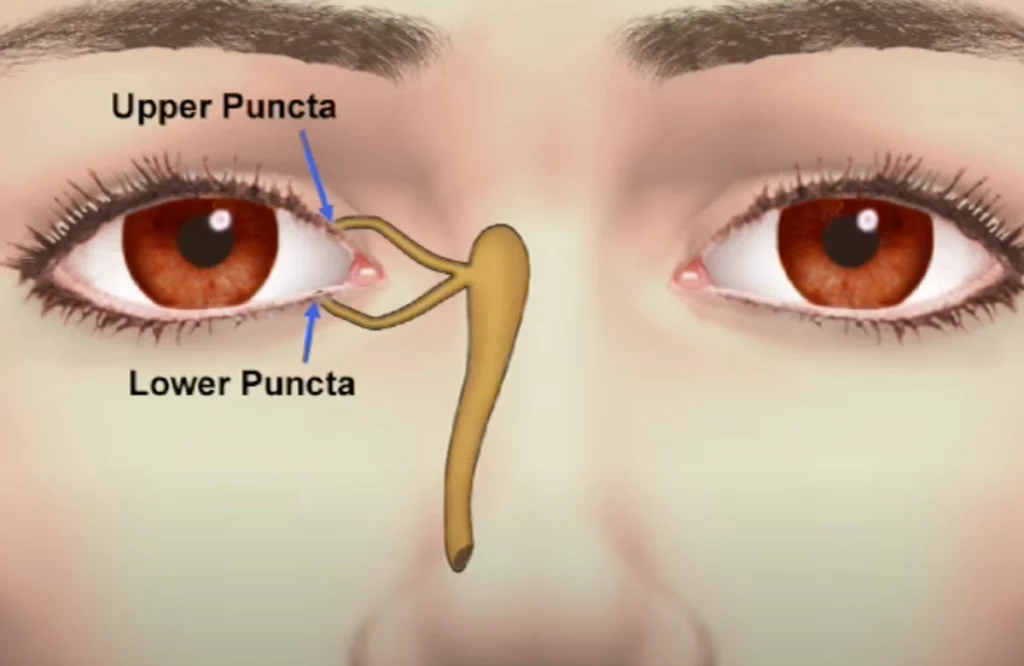 punctal plugs video poster