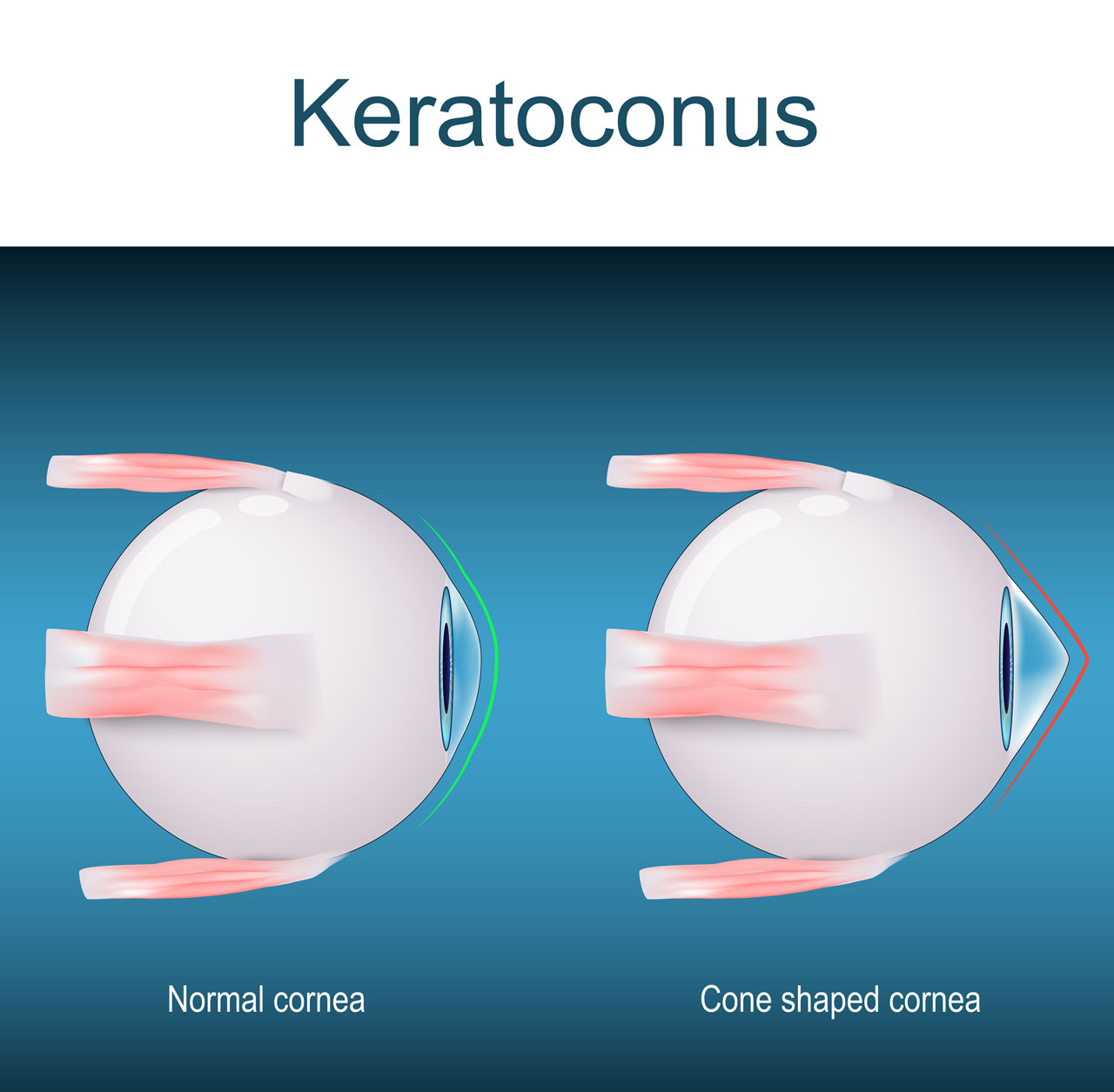 Keratoconus condition of the cornea graphic depiction