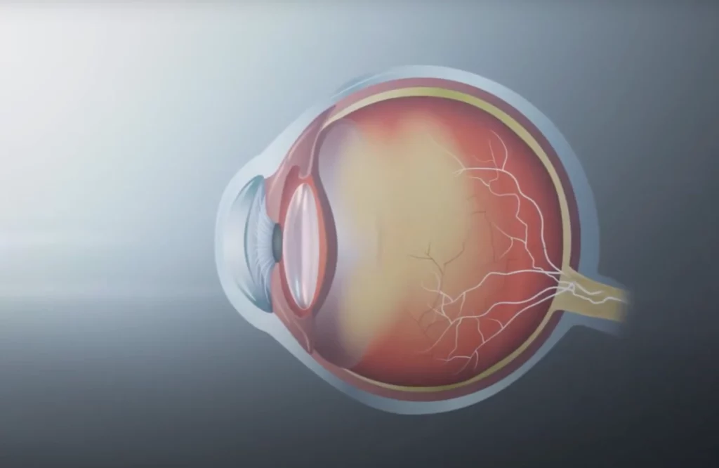 presbyopia eyeball diagram